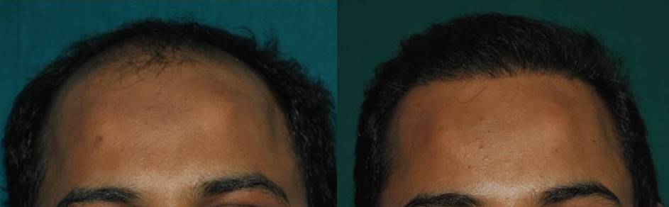 Good result of hair transplant in Kerala
